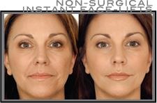 Non-surgical Facelifts | Pender Medi Spa vancouver