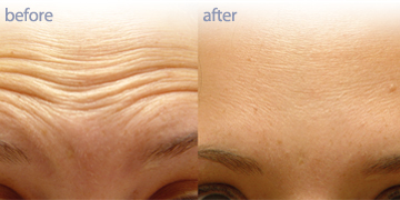 Botox before and after Vancouver| Pender Medi Spa | Skin Care Clinic