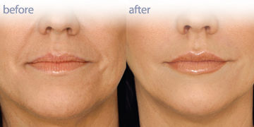 PenderMediSpa |温哥华真皮填充剂