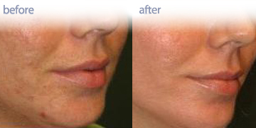 Glycolic Peel in Vancouver | Pender Medi Spa | Skin Care Clinic