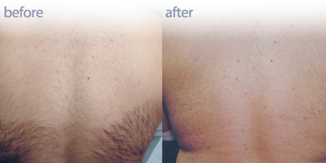 Laser Hair Removal Vancouver| Pender Medi Spa