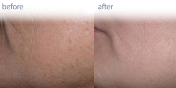 Microdermabrasion Vancouver | Pender Medi Spa | Skin Care Clinic