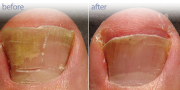 Laser Nail Fungus Treatment | Skin Care Clinic Vancouver