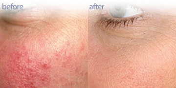 减少皱纹|皮肤护理诊所温哥华