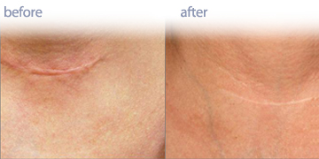 激光治疗疤痕温哥华|彭德的Medi温泉护肤诊所