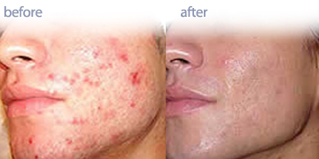 silkpeel皮肤输液温哥华彭德的Medi温泉