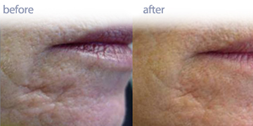 Skin Tightening Vancouver | Pender Medi Spa