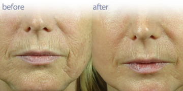 激光磨皮温哥华|彭德的Medi温泉