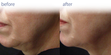 Skin Tightening Vancouver | Pender Medi Spa
