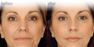 Non Surgical Facelifts Vancouver | Pender Medi Spa