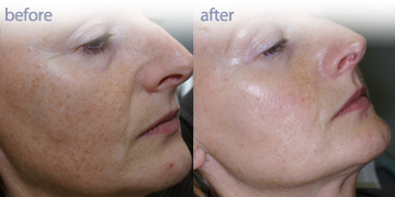 Sun Damage Treatment Vancouver | Pender Medi Spa | Skin Care Clinic