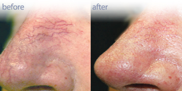 Laser Vein Reduction Vancouver | Pender Medi Spa