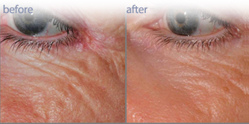 Wrinkle Reduction | Skin Care Clinic Vancouver