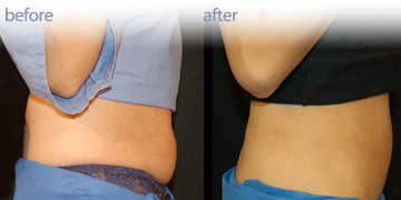 Lipo Dissolve Vancouver | Pender Medi Spa | Skin Care Clinic