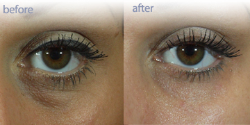 Under Eye Treatment | Before And After | Pender Medi Spa Vancouver