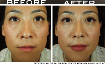 Asian Face Rejuvenation Vancouver | Pender Medi Spa