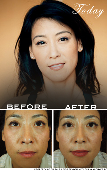 亚洲面孔| |皮肤护理诊所温哥华之前和之后复兴