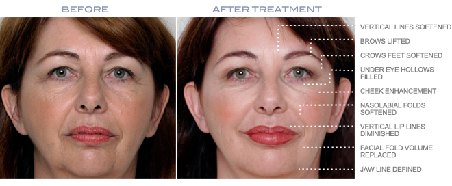 前后Juvederm处理照片PenderMediSpa温哥华