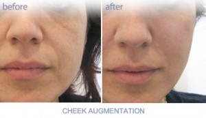 JUVEDERM - 奇克斯