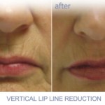 JUVEDERM垂直唇