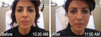 Before-and-After of Non-Surgical Face Lift | Physician Training Centre