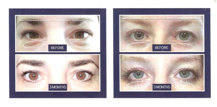 Before and after photo of eyes receiving Selphyl treatment | Pender Medi Spa Vancouver